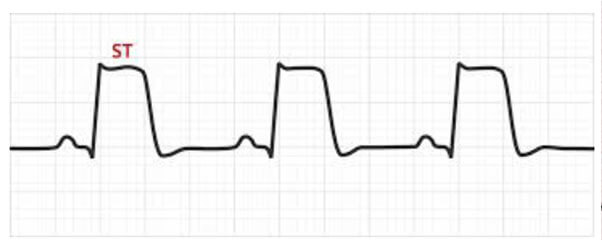 19th Ambulance – First Ambulance Ride